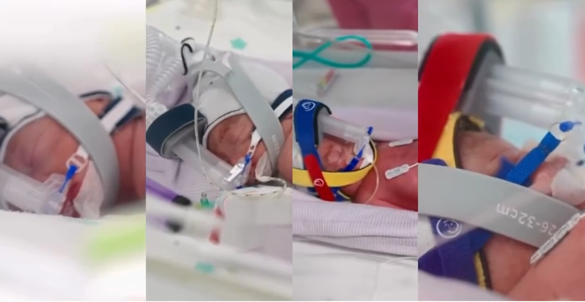 Un caso de 1 en 15 millones: nacen cuatrillizas idénticas que sorprenden a médicos y al mundo